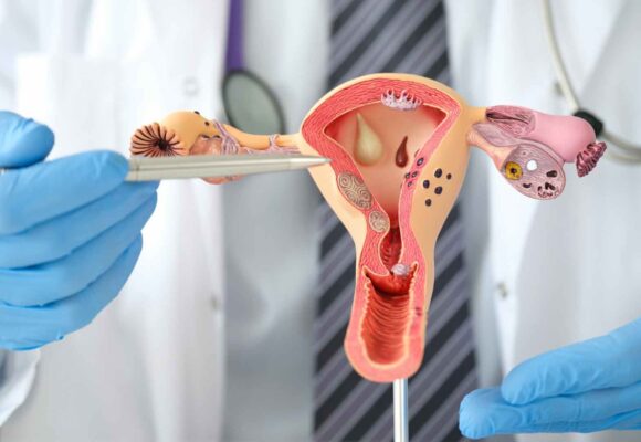 Endometriosis